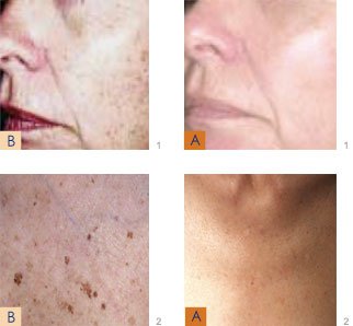 Skin Rejuvention treatment results : Before & After