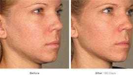 Ultherapy Treatment Results