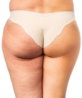 Butt cellulite treatment to enhance confidence at All About You Medical Spa in Fairfield CT.