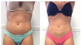 Coolsculpting in Fairfield Medical Spa