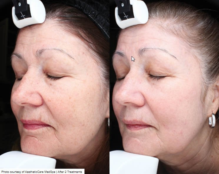 Halo Before & After Results*