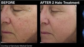 Halo Laser Treatment at All About You Medical Spa