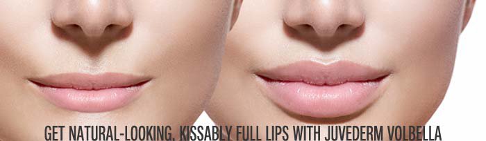 Natural looking & fuller lips with Juvederm Volbella
