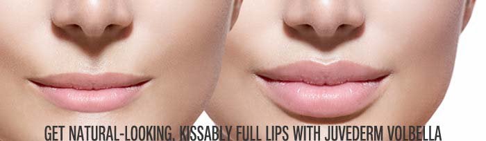 Natural Looking & Fuller Lips With Juvederm Volbella in Fairfield CT