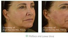 NovaThreads Non-Surgical Facelift