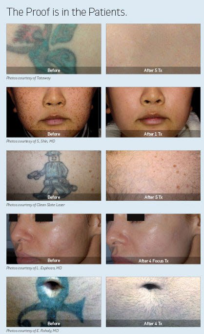 picosure laser skin treatment results