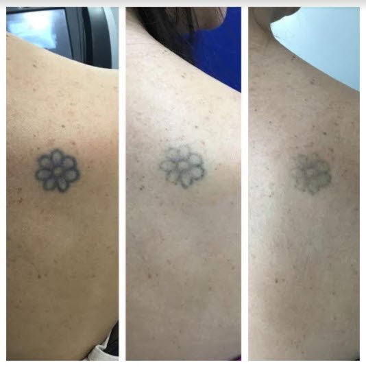 Picosure treatment results