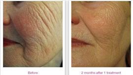 Profound Skin Tightening Treatment in Fairfield, CT