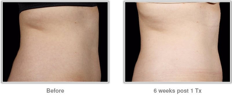 sculpsure fat reduction results