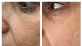 Microneedling Treatment in Fairfield, CT