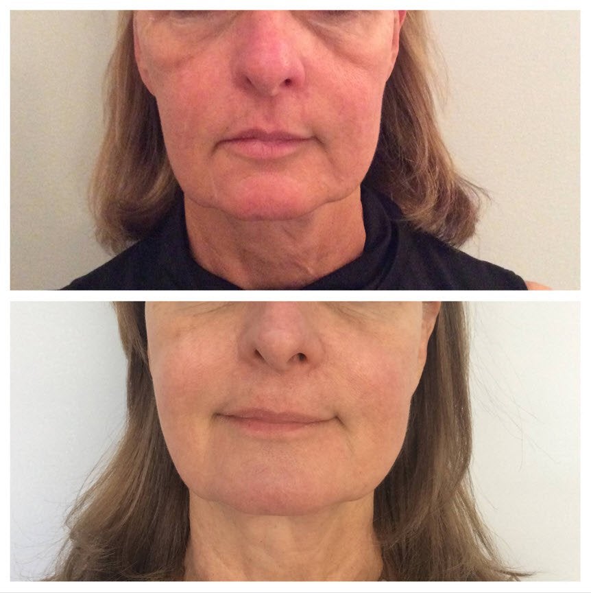 Ultherapy Price Malaysia